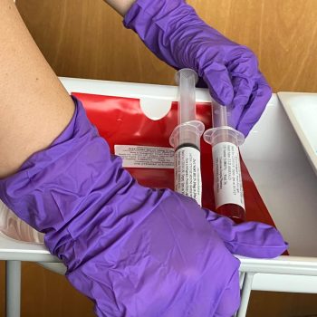 End of phase 1 – Refractory ETP-ALL & chemo #10